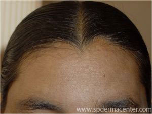 Melasma-After